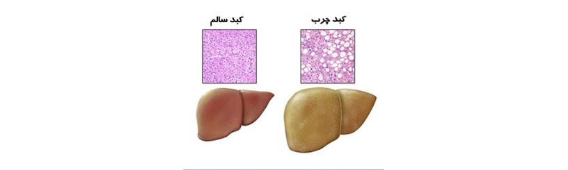 چه کسانی کبد چرب می گیرند؟