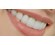سفیدکردن دندان  