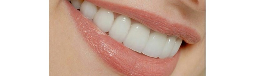سفیدکردن دندان  