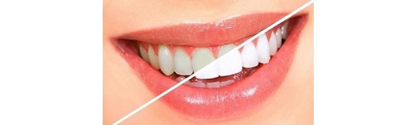  ‌روش های سفید کردن دندان