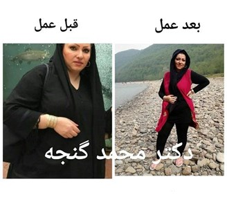 بهترین جراح چاقی اسلیو تهران